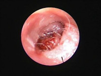耳道内腫瘤